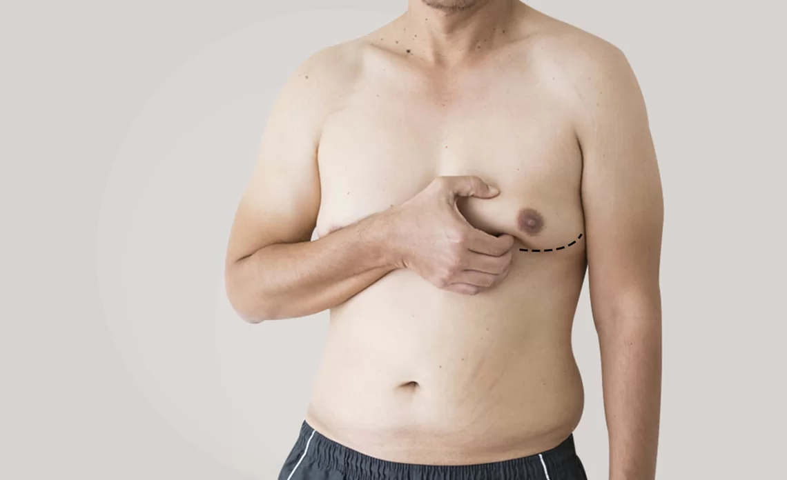 Gynecomastia In Men: Causes, Treatments, And The Path To Chest Reduction Surgery